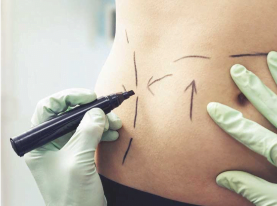 Cui i se poate adresa o procedura de liposuctie